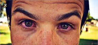 In fact, it is even good for your health. How To Clear The Redness In My Eyes After Smoking Weed Quora