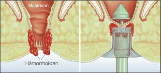 Auch ein analekzem kann anzeichen für hämorrhoiden sein. Hamorrhoiden Alles Zu Symptomen Behandlung Und Ursachen