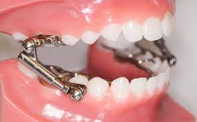 All About The Fixed Functional Appliance Or Herbst Appliance Bronsky Orthodontics Nyc