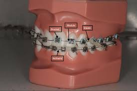 Orthodontics Australia | How do braces work?