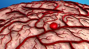 Перевод песни aneurysm — рейтинг: Brain Aneurysm Brain Institute Ohsu