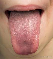 What Are The Signs Of An Azithromycin Allergy With Pictures