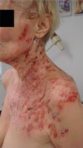 Ð ÐµÐ·ÑÐ»ÑÐ°Ñ ÑÐ»Ð¸ÐºÐ° Ð·Ð° herpes zoster