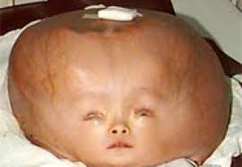 Image result for Hydrocephalus