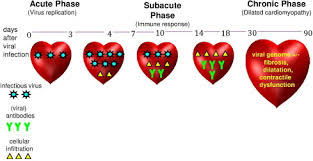 Myocarditis is a rare but serious condition that. Update On Myocarditis Sciencedirect