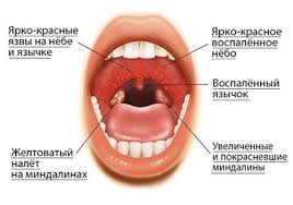 Bol V Gorle Otdaet V Uho Prichiny Simptomy I Lechenie
