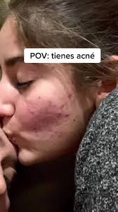 Consejos para tratar el acné: bicarbonato y zote en la cara