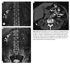 Image result for Nephrolithiasis Imaging