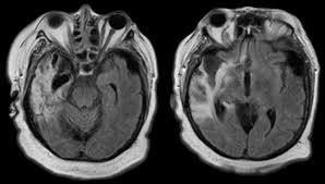 The differential diagnoses include limbic encephalitis (paraneoplastic), gliomatosis cerebri, and status epilepticus. Hsvolda
