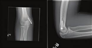 The medial and lateral epicondyles are easily palpable, and form the sites of origin for the forearm flexors of the anterior compartment and forearm. Http Upoj Org Wp Content Uploads V27 063 Carney Pdf