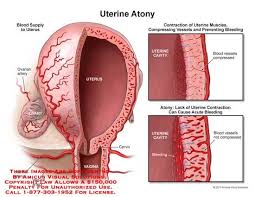 Uterine Atony Nursing Instructor Nurse Case Reproductive System