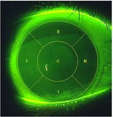 Full Text A Novel Scale For Describing Corneal Staining Opth