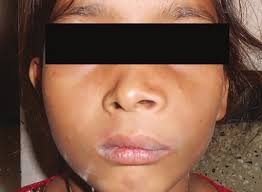 Patient showing the presentation as any other maxillary sinus lesion