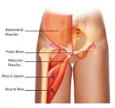 Anatomy of the groin area superficial muscles and deep muscles in this image, you will find rectus abdominis, external oblique, inguinal ligament, tensor fascia lata, gracilis, sartorius, rectus femoris, the iliotibial band in it. Groin Muscle Anatomy Anatomy Drawing Diagram