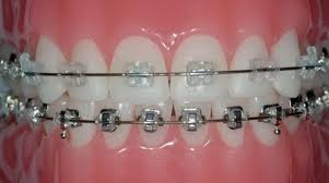 If you've got braces, using a special toothpaste is the best way to keep them clean. Metal Vs Ceramic Braces Which Dental Brace Is Better