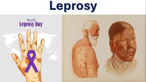Image result for Leprosy