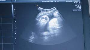 Getting a scan during pregnancy is truly magical. When And Why To Get Ultrasounds During Pregnancy The New York Times