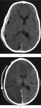 Nonaccidental Head Injury In Infants The Shaken Baby Syndrome Nejm