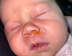 Image result for yellow scabs on the face in children