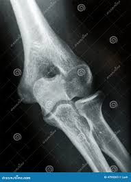 Image result for Elbow XRay