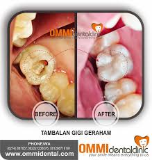 Gigi bungsu merupakan gigi geraham ketiga dan geraham terakhir yang tumbuh. Klinik Gigi Ommi Dental Photos Facebook