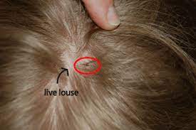 Kutu rambut merupakan parasit yang menetap di rambut dan menyebabkan efek negatif dan berbahaya bagi penderitanya. Basmi Kutu Rambut The Way That To Alloh As A Right God