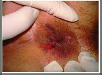 Résultat de recherche d'images pour "hemorrhoids?"