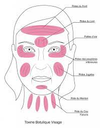 Les miennes apparaissent dans certains des coins les plus étranges de mon visage de 54 ans. Injection De Botox A Paris Dr Guy Haddad