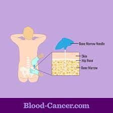 Risks of a bone marrow biopsy How Are Bone Marrow Tests Used To Diagnose Blood Cancer