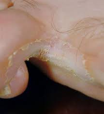 The diagnosis is based on the location and appearance of the rash and sometimes on an analysis of skin scrapings and culture. Intertrigo Deximed