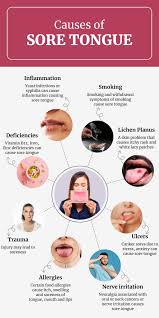 Image result for mouth ulcer on tongue)