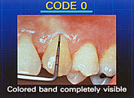 periodontal screening and recording early detection of