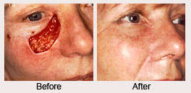 On the one hand, it is fairly easy to detect and treat when done so at an early stage. Moh S Reconstruction For Skin Cancer Specialist Upper East Side New York Ny Elliott H Rose Md Plastic Surgeon The Aesthetic Surgery Center