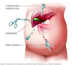 Image Showing Laparoscopic Cholecystectomy Gallbladder Surgery Gallbladder Abdominal Surgery