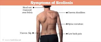 Scoliosis Facts Causes Types Symptoms Treatment
