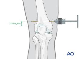 It can also be used furthermore, how do you give skin traction? Traction And Bed Rest For Fracture Of The Femur Distant To The Implant