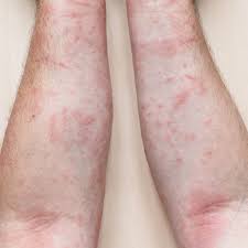 Image result for Skin Infection