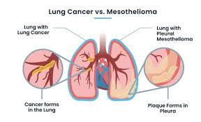 Jul 05, 2013 · not all pain has the same intensity. Pleural Mesothelioma Vs Lung Cancer Diagnosis Treatment