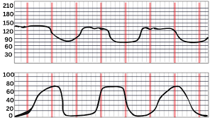 Image result for Late Deceleration