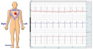 109 3 6 and 12 lead ecg biopac