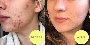 A Cara Da Eritretina E O Tratamento Do Ponto Da Pele Acne Para A Pele Propensa Da Acne Trata A Acne Cistica Remocao Avancada Da Acne De Acao Rapida Maquiagem