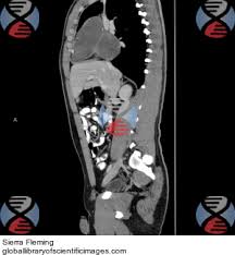 Image result for Incidental Imaging Finding