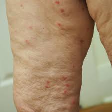 Image result for Papular urticaria