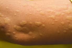 Tablets, liquid gels, dissolve tabs, allergy syrup Allergic To The Cold Temperatures It S Real For Some Health Beat