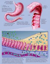 Pin On Crohns Disease Irritable Bowel Disease