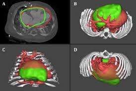 3D images aid selection of heart transplant donors