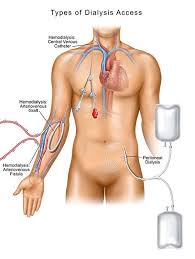 It is a form of venous access. 5 Common Central Venous Catheter Cvc Complications