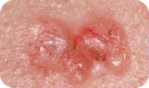 Cancerous growths develop when unrepaired dna damage to skin cells (most often caused by ultraviolet radiation from sunshine or tanning beds) triggers mutations (genetic defects) that lead the skin cells to multiply rapidly and form malignant tumours. Skin Cancer Overview Cancer Council Victoria