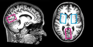 Lantas bagaimana cara download dan setting x8 speeder di game higgs domino island. 7t Proton Magnetic Resonance Spectroscopy Of Gamma Aminobutyric Acid Glutamate And Glutamine Reveals Altered Concentrations In Patients With Schizophrenia And Healthy Siblings Biological Psychiatry