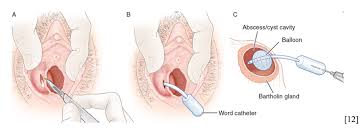 Image result for Bartholin's gland abscess